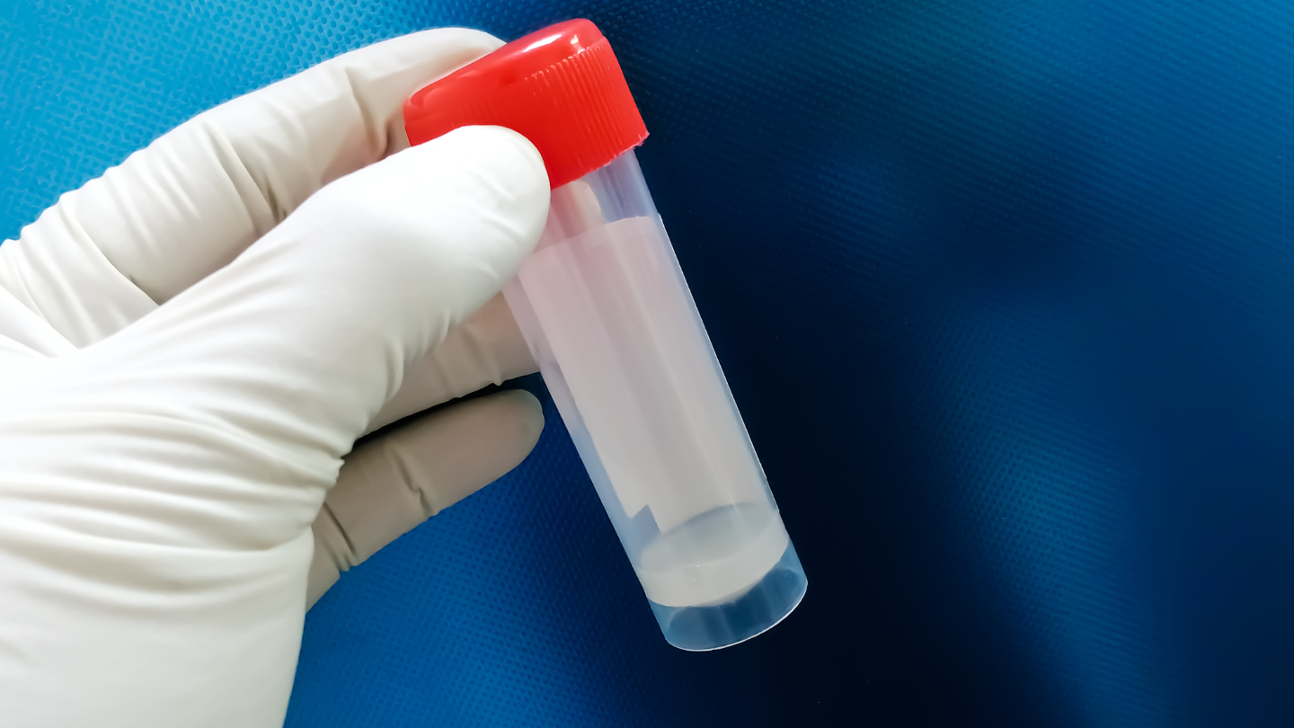 Thời gian vận chuyển mẫu tinh dịch sau khi lấy ảnh hưởng đến kết quả tinh dịch đồ