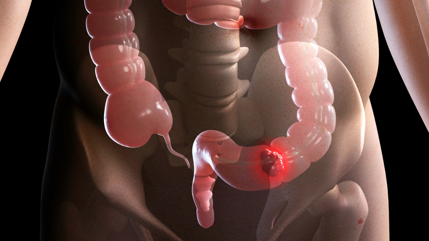 Nếu thoát vị bẹn không điều trị kịp thời có thể dẫn tới biến chứng tắc ruột