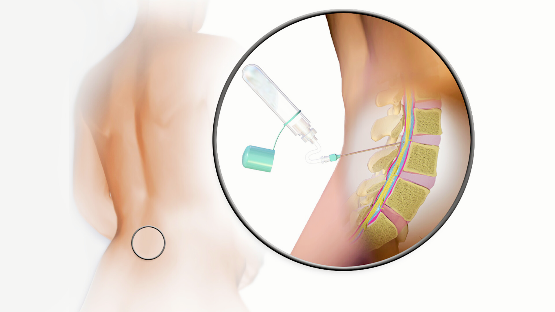 Một số trường hợp cần chọc dò dịch não tủy tìm nguyên nhân suy giảm nhận thức