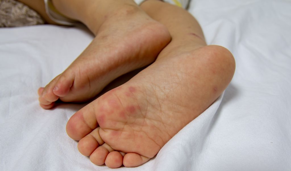 Các nốt phỏng nước đặc trưng của bệnh tay chân miệng xuất hiện ở lòng bàn chân bé