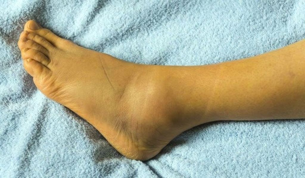 Hình ảnh minh họa triệu chứng vàng da có thể gặp ở bệnh nhân mắc viêm gan E