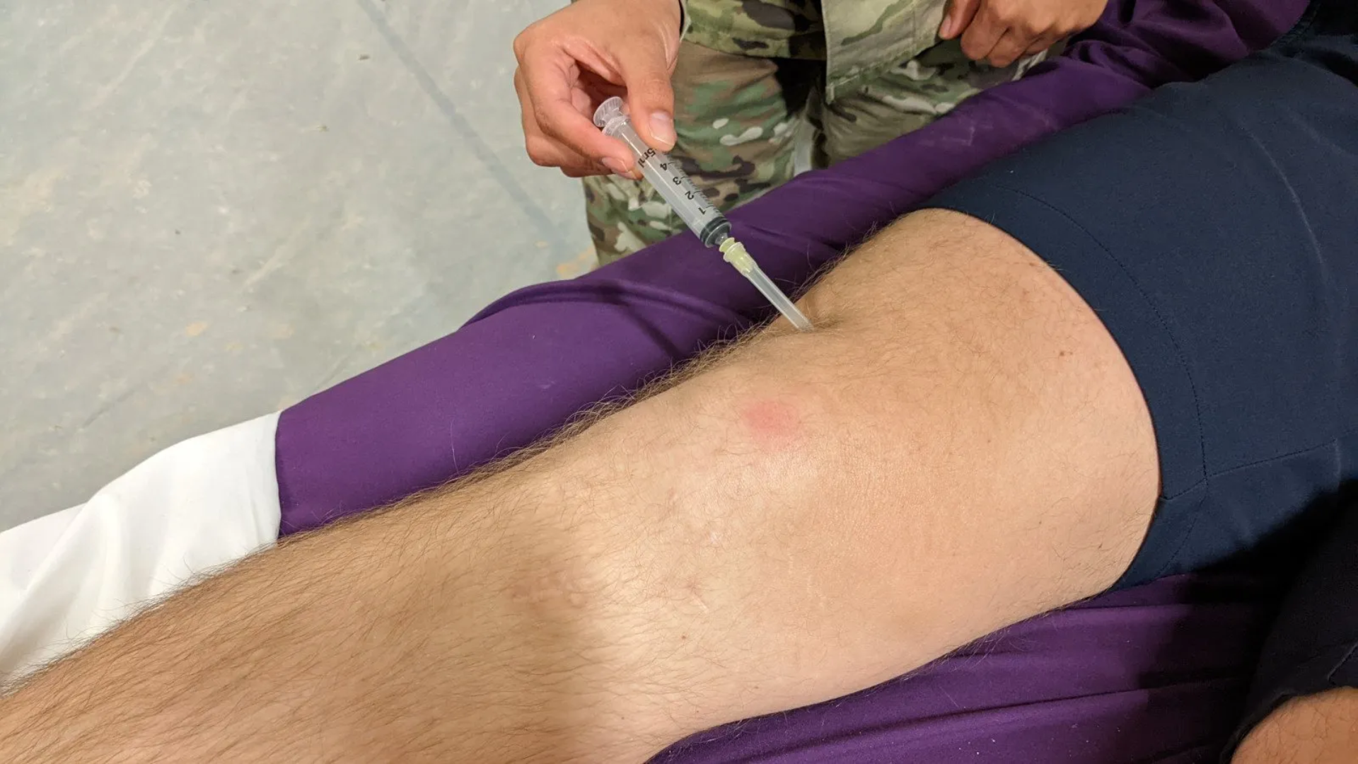 Rút dịch khớp để xét nghiệm