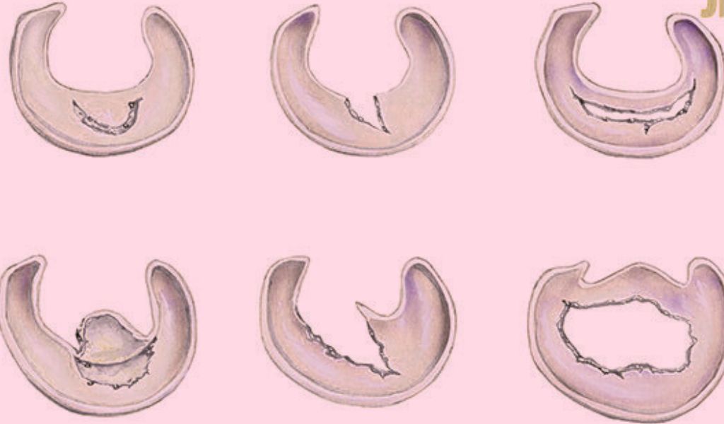 Các dạng phổ biến của rách sụn chêm đầu gối như rách dọc, rách ngang và rách hình vạt