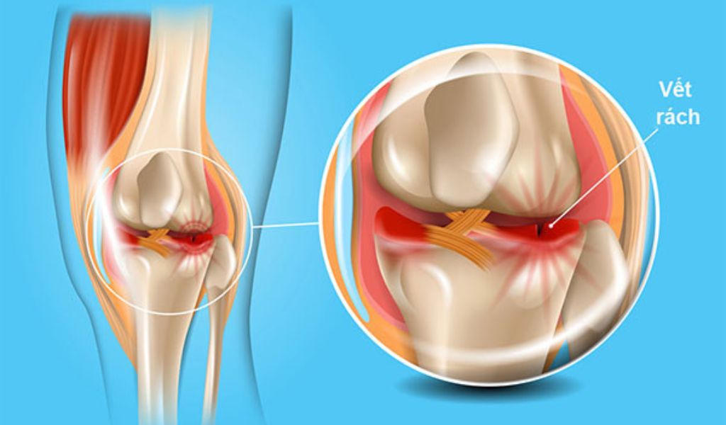 Thoái hóa khớp gối ở người lớn tuổi làm tăng nguy cơ rách sụn chêm ngay cả khi vận động nhẹ