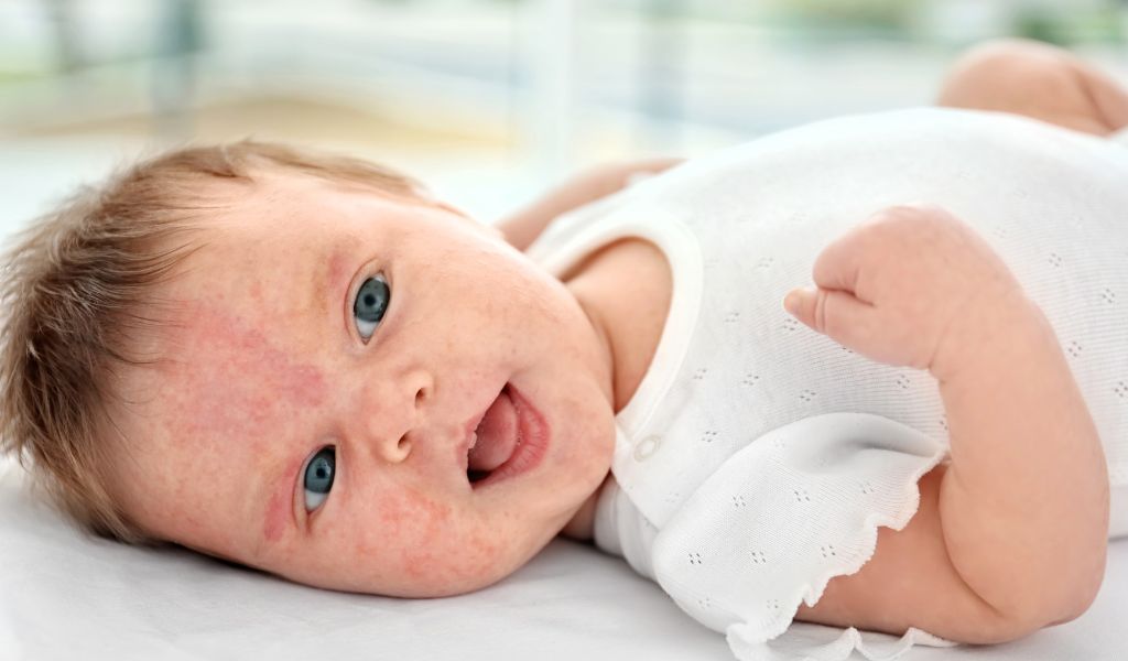 Cần đưa trẻ đi khám bác sĩ nếu rôm sảy có dấu hiệu lan rộng hoặc mưng mủ