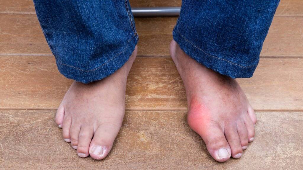 Khớp bị cong vẹo hoặc phồng to bất thường là một trong 7 dấu hiệu của viêm khớp ngón chân