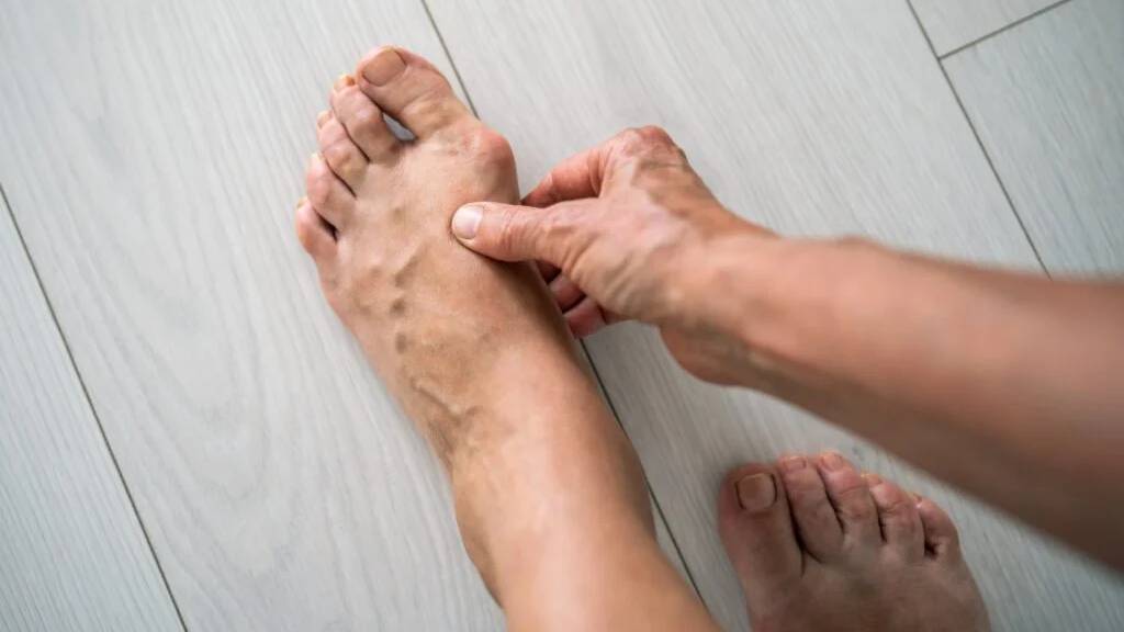 Người cao tuổi dễ mắc bệnh viêm khớp ở ngón chân hơn do thay đổi nội tiết và loãng xương