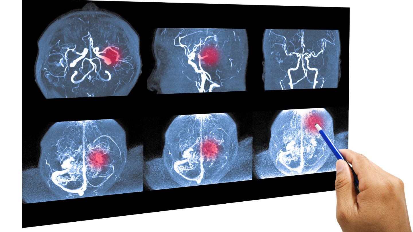 Chụp cộng hưởng từ mạch máu não (MRA) là một trong những phương pháp quan trọng giúp chẩn đoán thiếu máu não