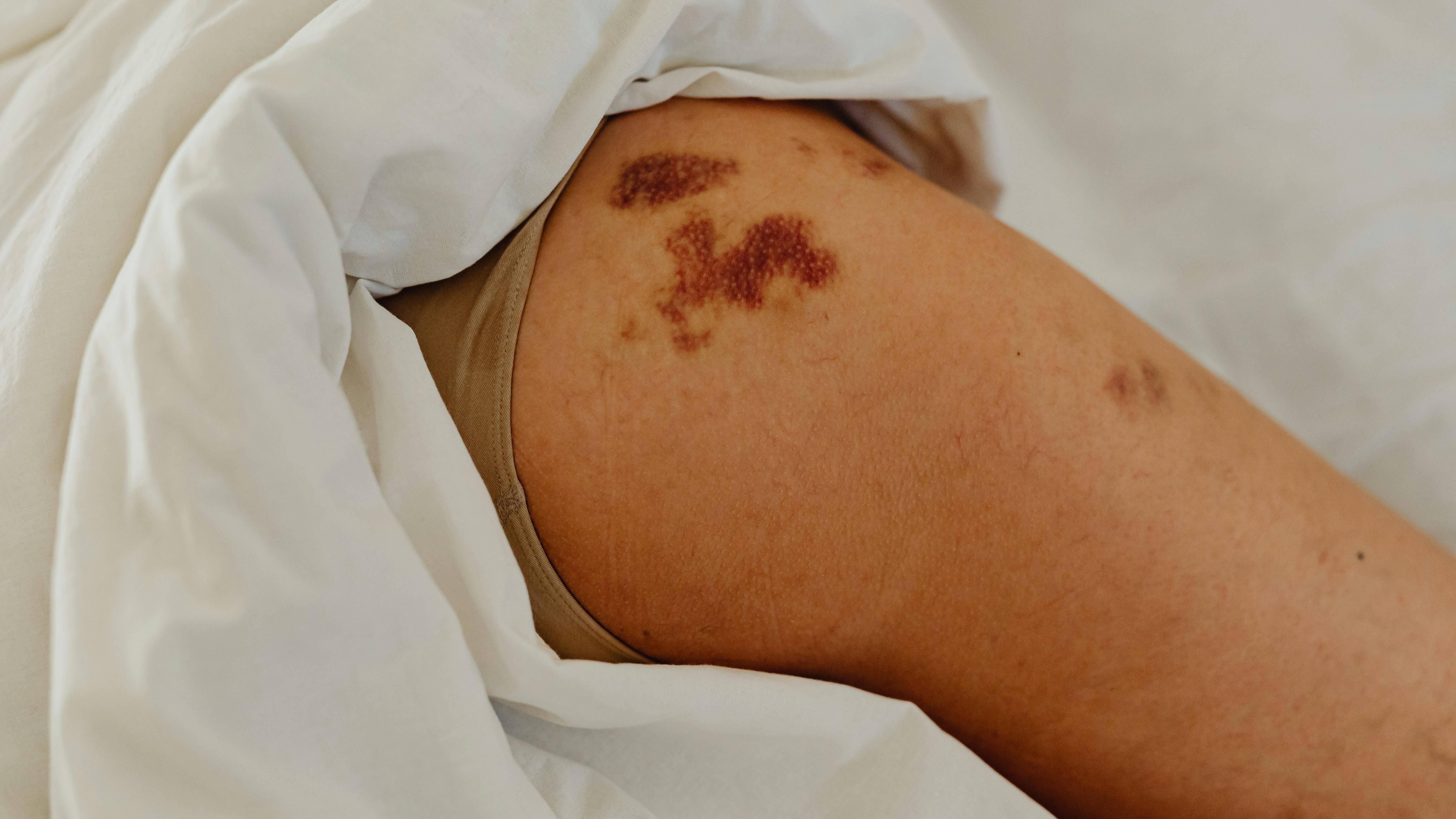 Da dễ bầm tím dù chỉ va chạm nhẹ, lâu tan hơn bình thường và dễ chảy máu