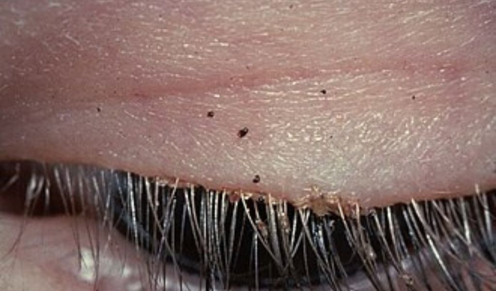 Rận mu ký sinh ở lông mi có thể gây ngứa mắt, kích ứng và tăng nguy cơ viêm kết mạc