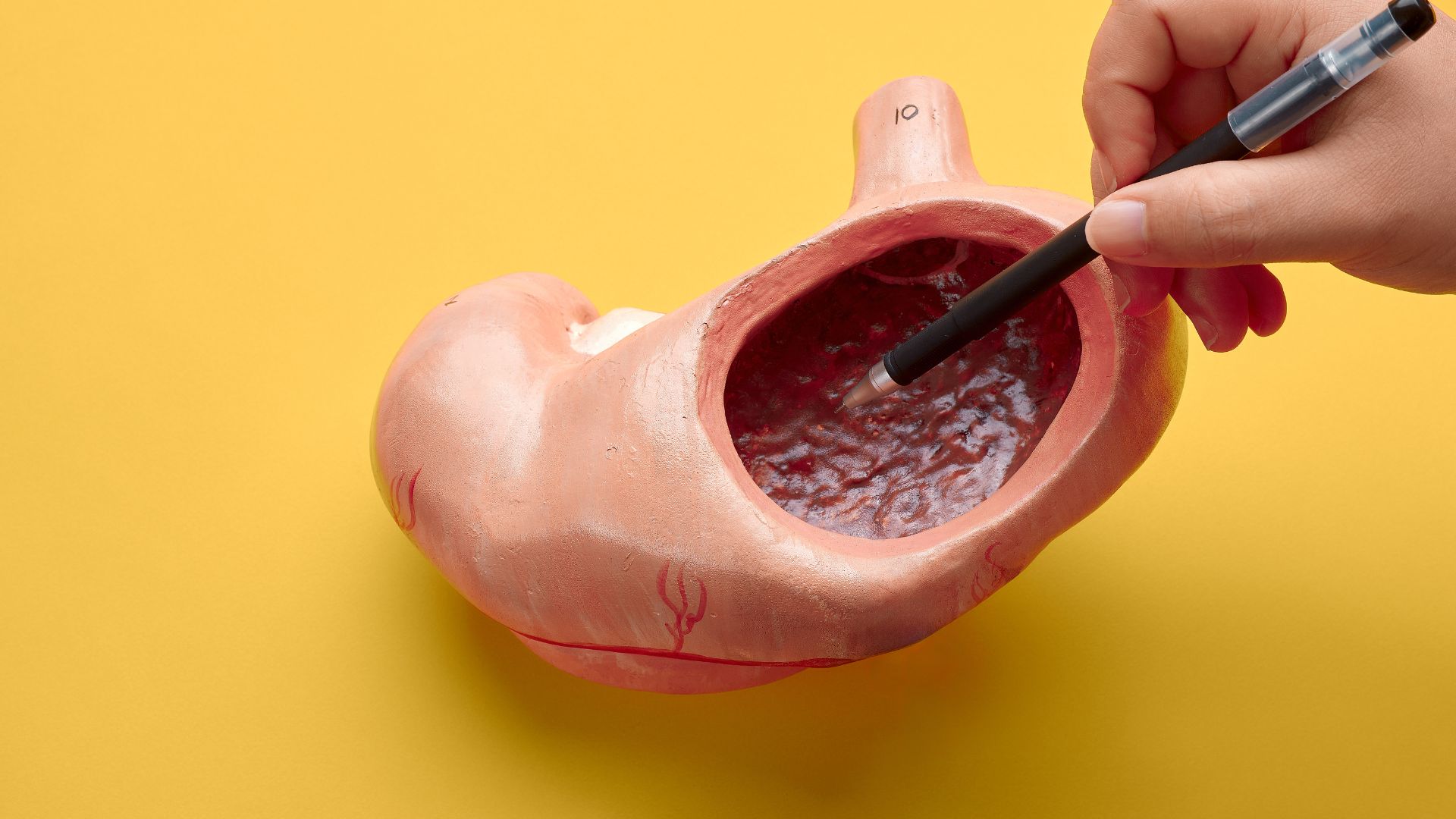 Nguyên nhân chính gây bệnh Barrett thực quản là trào ngược dạ dày thực quản (GERD) mạn tính