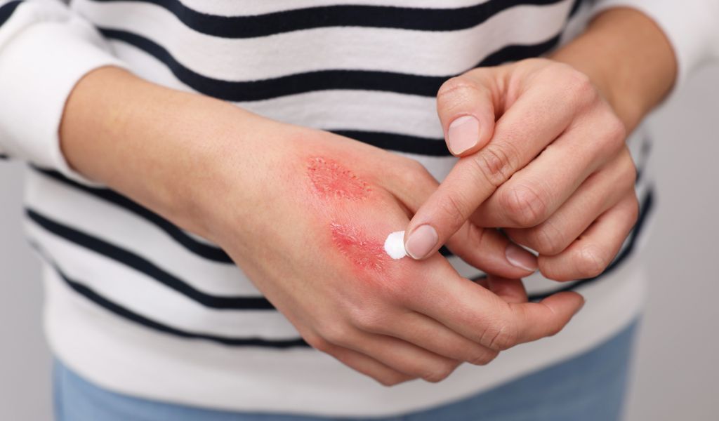 Sử dụng thuốc bôi là một trong những cách chữa viêm da cơ địa phổ biến hiện nay