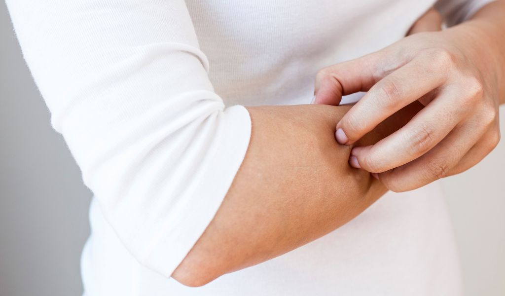 Người bệnh không nên gãi mà nên ấn nhẹ hoặc chườm lạnh để giảm khó chịu