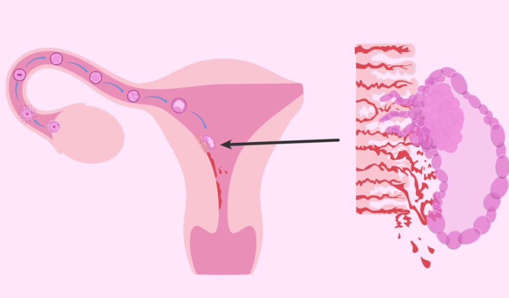 Trong quá trình làm tổ, phôi nang xâm nhập vào nội mạc tử cung và làm vỡ các mạch máu