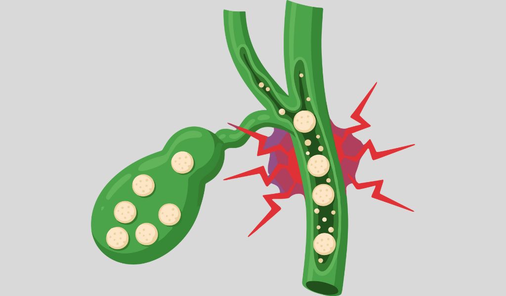 Nhiễm cholesterol túi mật không điều trị có nguy cơ hình thành sỏi mật
