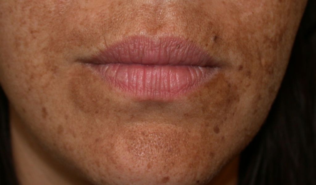 Da bị nám nhẹ với các đốm tăng sắc tố, không bong tróc