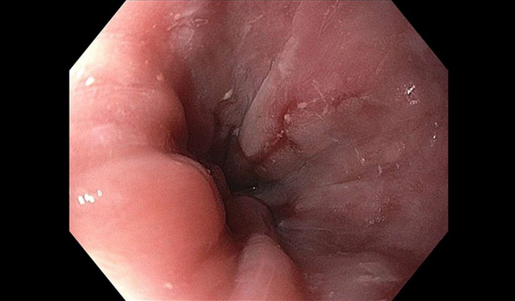 Viêm thực quản nhẹ gây tình trạng trào ngược dạ dày độ B
