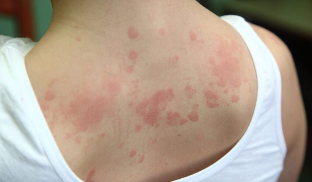Hình ảnh bệnh phong ngứa với những nốt mẩn đỏ dạng mảng, lan rộng trên bề mặt da