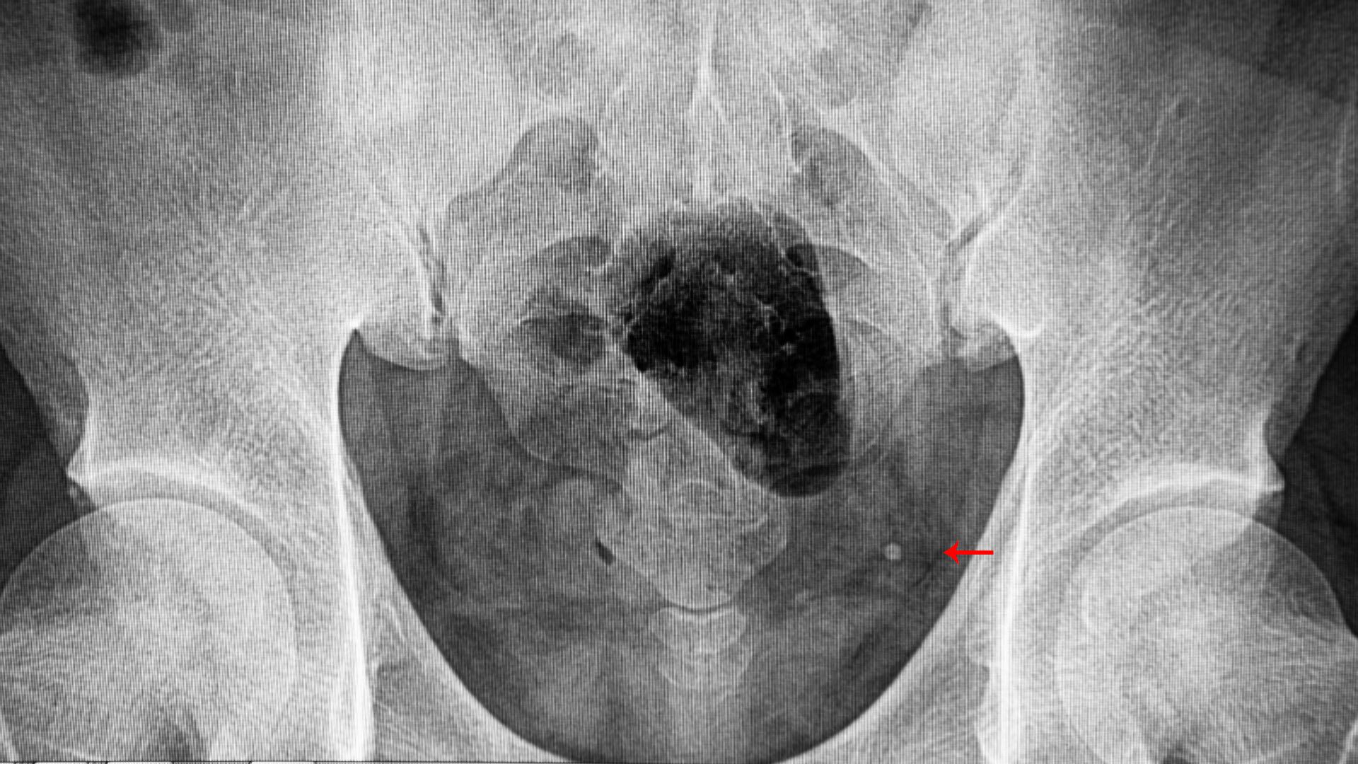 Sỏi cọ xát gây viêm, loét niêm mạc và hình thành sẹo xơ sau quá trình lành thương