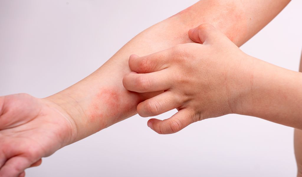 Da đỏ, nổi mụn nước li ti khiến trẻ ngứa và gãi nhiều, dễ để lại sẹo