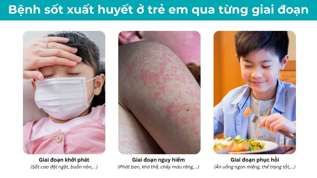 Hình ảnh sốt xuất huyết của trẻ em qua từng giai đoạn
