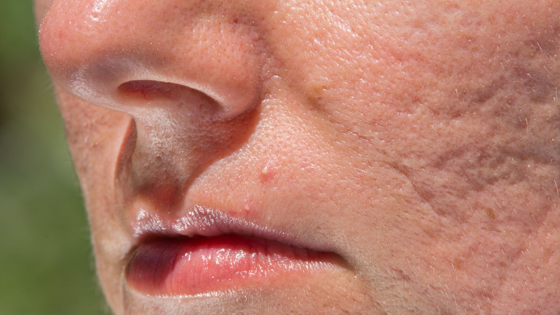 Công nghệ Laser CO2 Fractional giúp điều trị sẹo rỗ và sẹo mụn