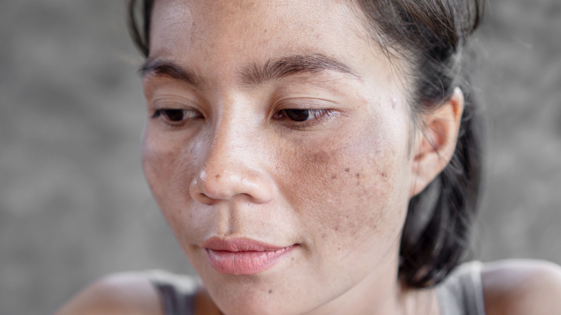 Laser CO2 Fractional hỗ trợ trị nám và tàn nhang hiệu quả