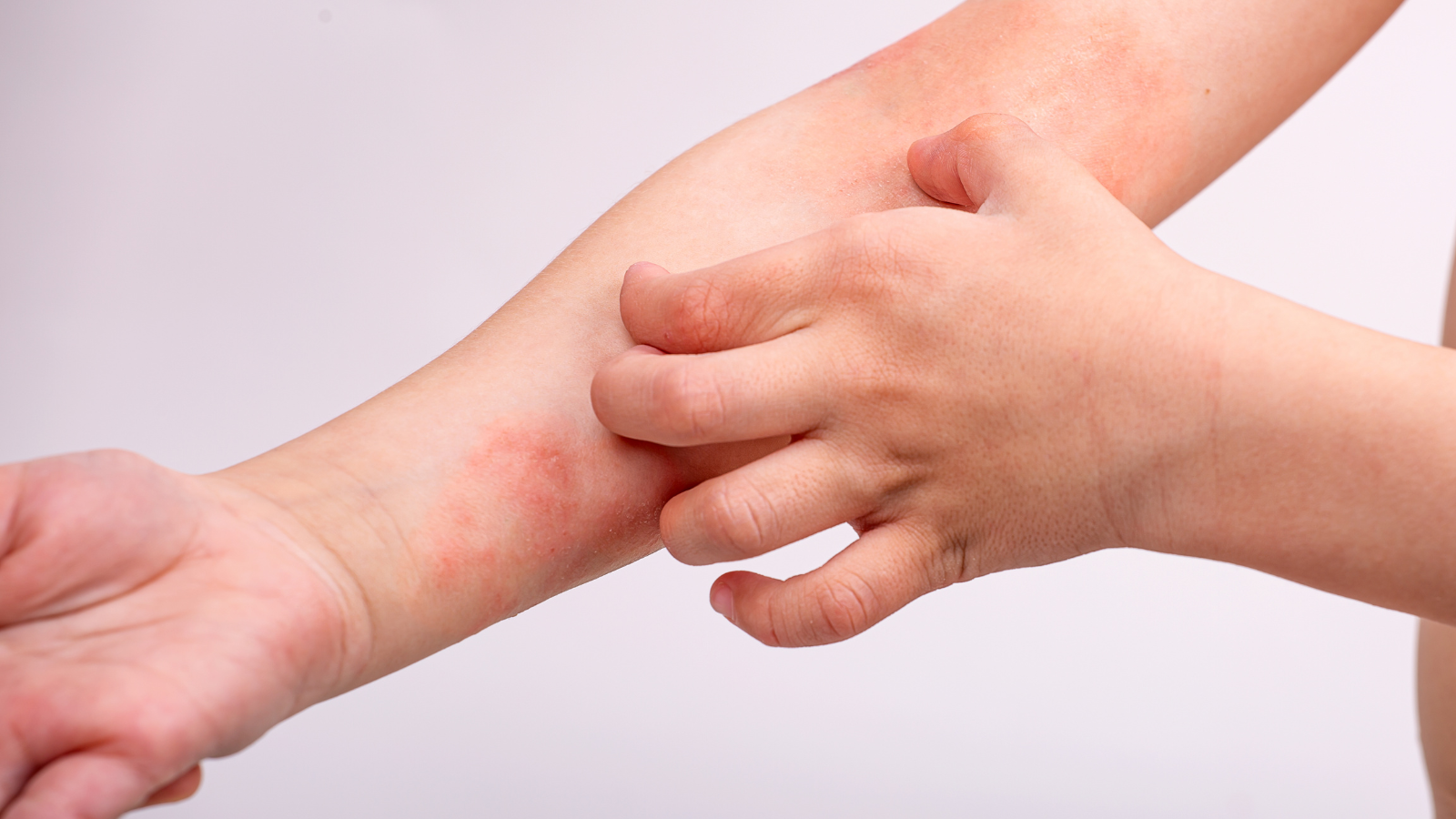 Mảng bệnh chàm đồng tiền thường có hình tròn như đồng xu, đỏ và ngứa dai dẳng