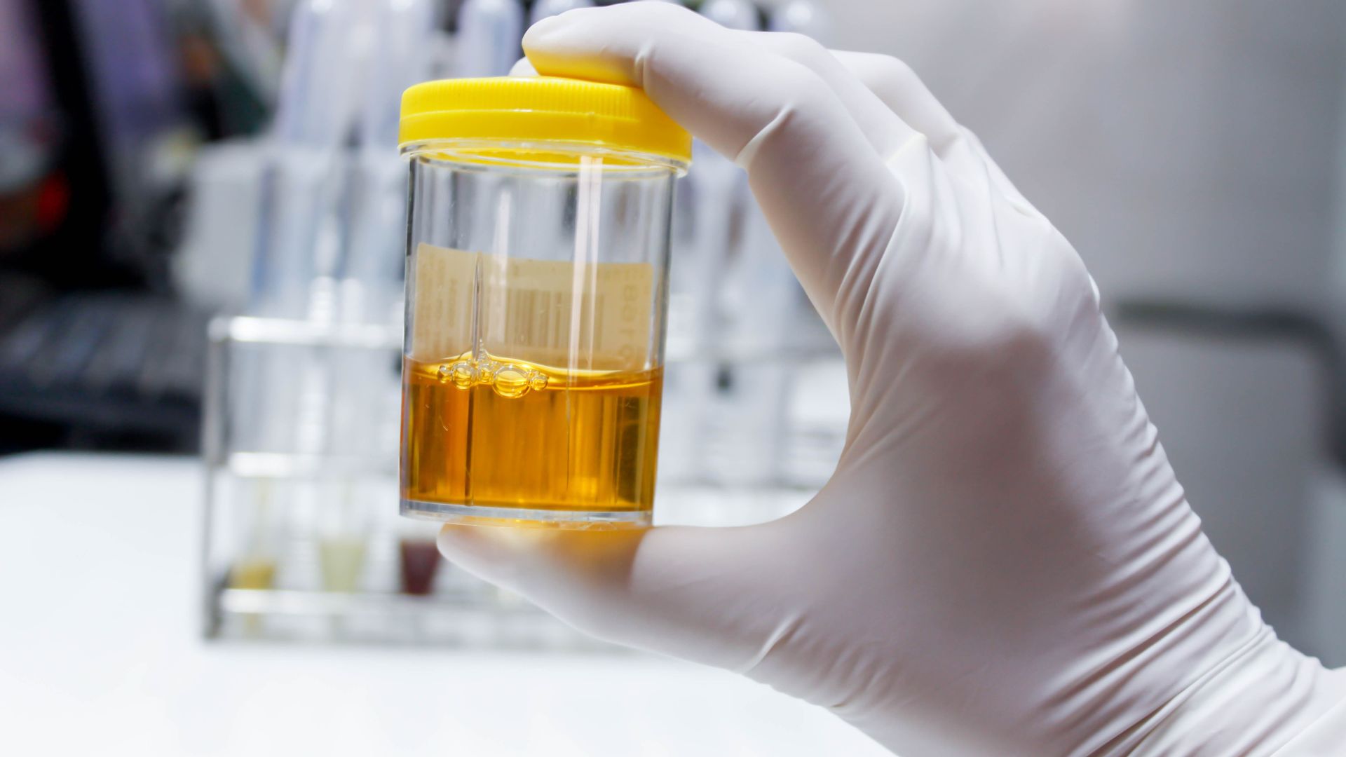 Xét nghiệm metanephrine có giá trị cao trong phát hiện các bệnh lý nội tiết hiếm gặp