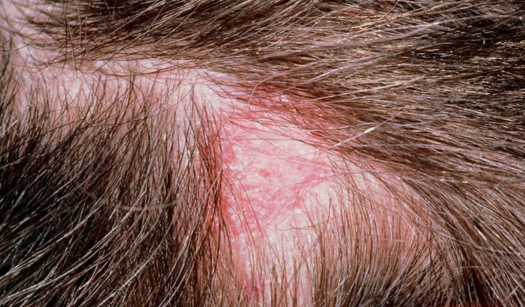 Bệnh nấm da đầu có lây không? Câu trả lời là bệnh có thể lây qua tiếp xúc trực tiếp