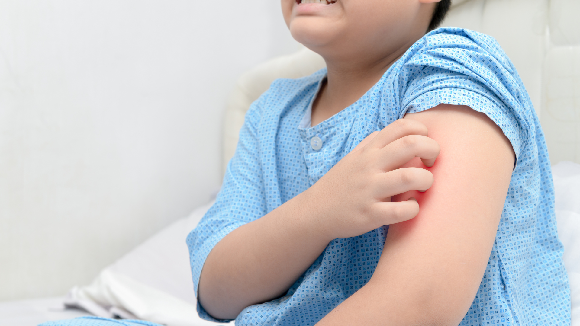 Nổi mề đay ở trẻ em kiêng gì và nên ăn gì để giảm mẩn ngứa 3.png