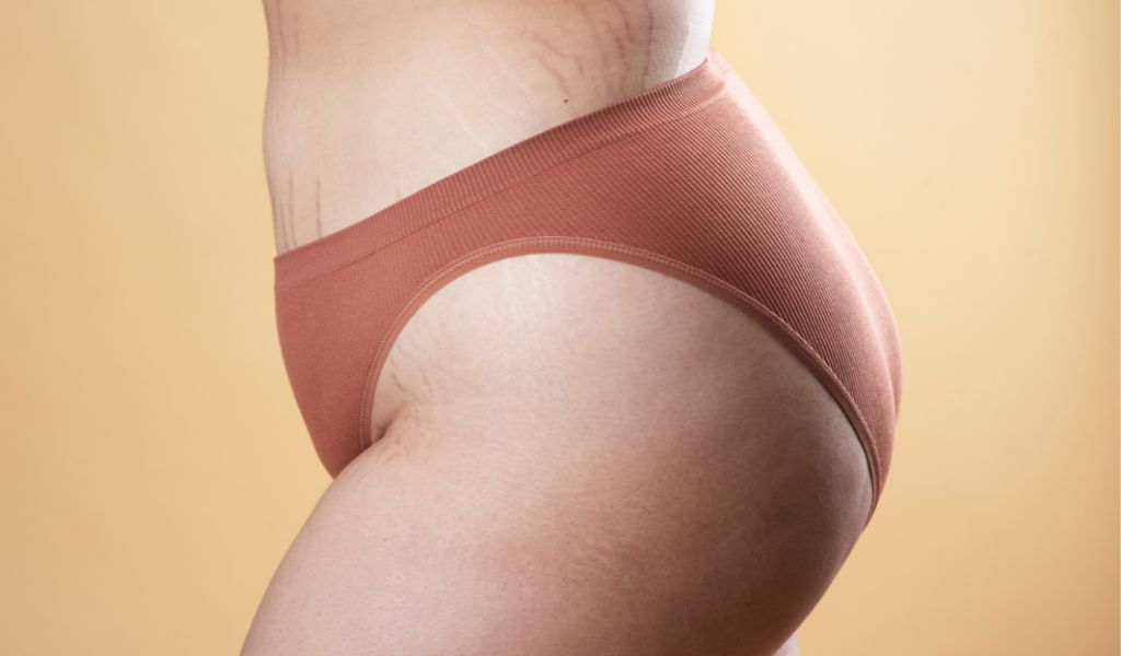 Vết rạn có thể có màu hồng, tím hoặc trắng bạc tùy thuộc vào giai đoạn hình thành