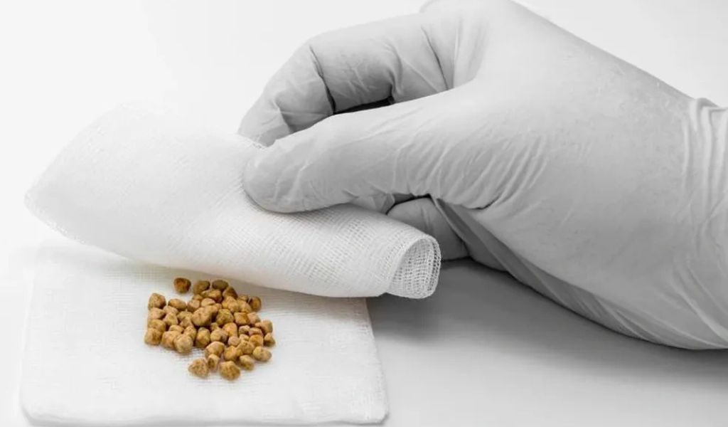 Sỏi cholesterol túi mật thường có màu vàng nhạt hoặc trắng đục, hình cầu tròn hoặc đa diện với các cạnh sắc nét