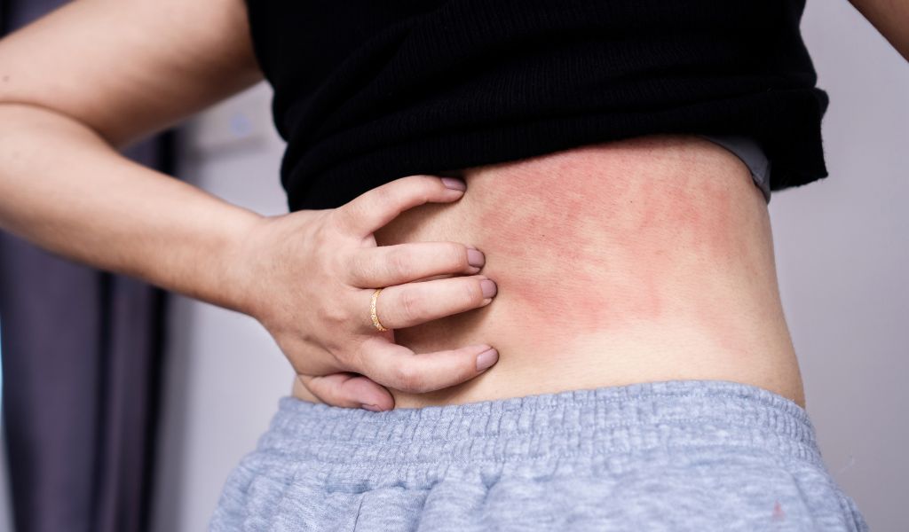 Phát ban ngoài da là một trong những triệu chứng điển hình của sốt siêu vi người lớn