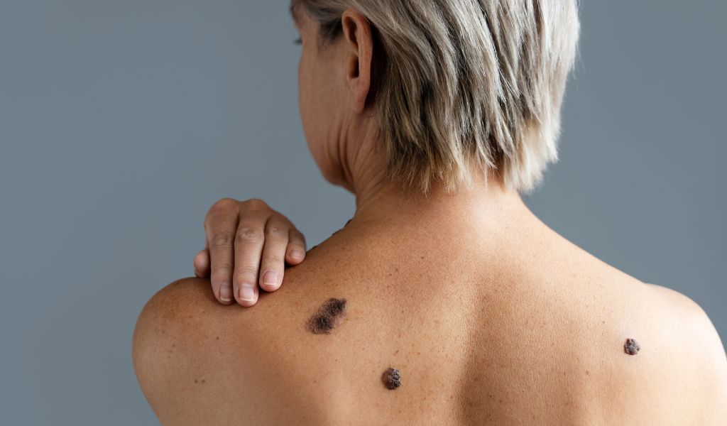Loại ung thư đặc thù như ung thư sắc tố (Melanoma)