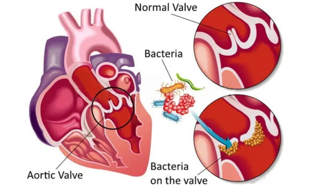 Vi khuẩn xâm nhập vào máu gây nhiễm trùng lớp lót trong tim và van tim