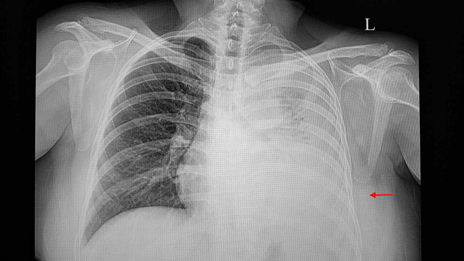 Tràn dịch màng phổi ác tính là dạng tràn dịch do di căn của tế bào ung thư