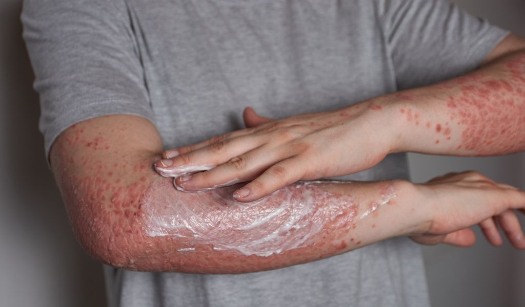 Dưỡng ẩm đều đặn giúp giảm khô ráp, bong tróc và tăng cường hàng rào bảo vệ da