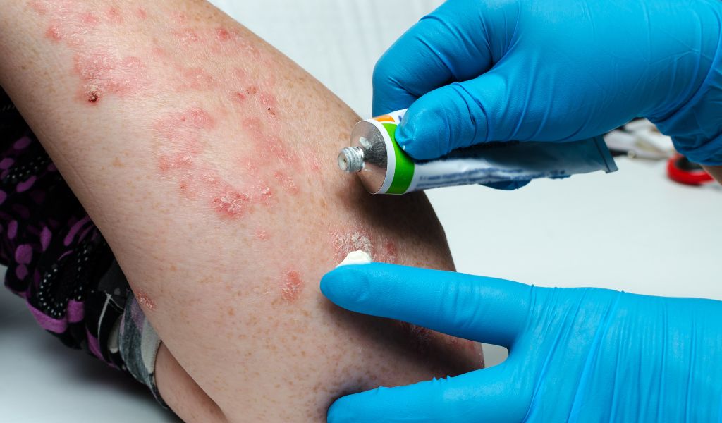 Chăm sóc da đúng cách giúp hạn chế tái phát viêm da cơ địa