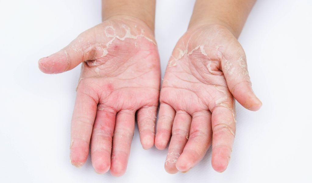 Da tay khô, nứt nẻ, làm người bệnh đau rát và khó khăn trong sinh hoạt