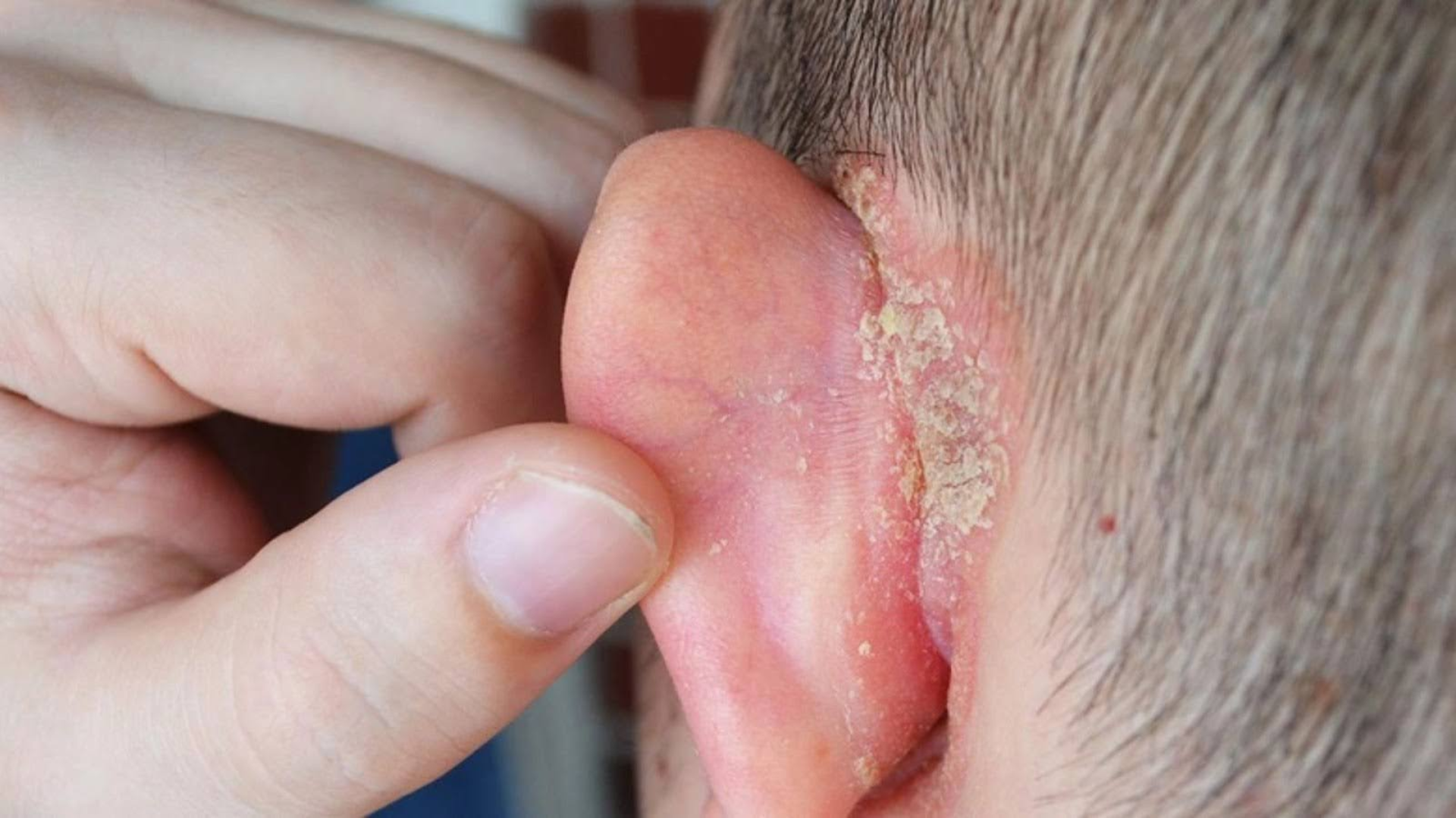 Vành tai bị đóng vảy ở trẻ sơ sinh Nguyên nhân và cách xử lý an toàn 1.png
