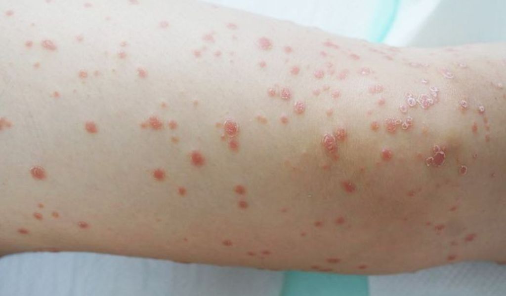 Vảy nến thể giọt là tình trạng da xuất hiện đốm nhỏ rải rác, có vảy và trông như giọt nước