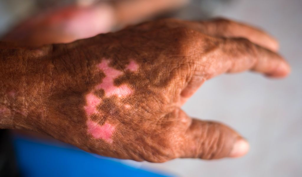 Mycobacterium leprae gây tổn thương da với các mảng nhạt màu hoặc đỏ sẫm tiến triển chậm