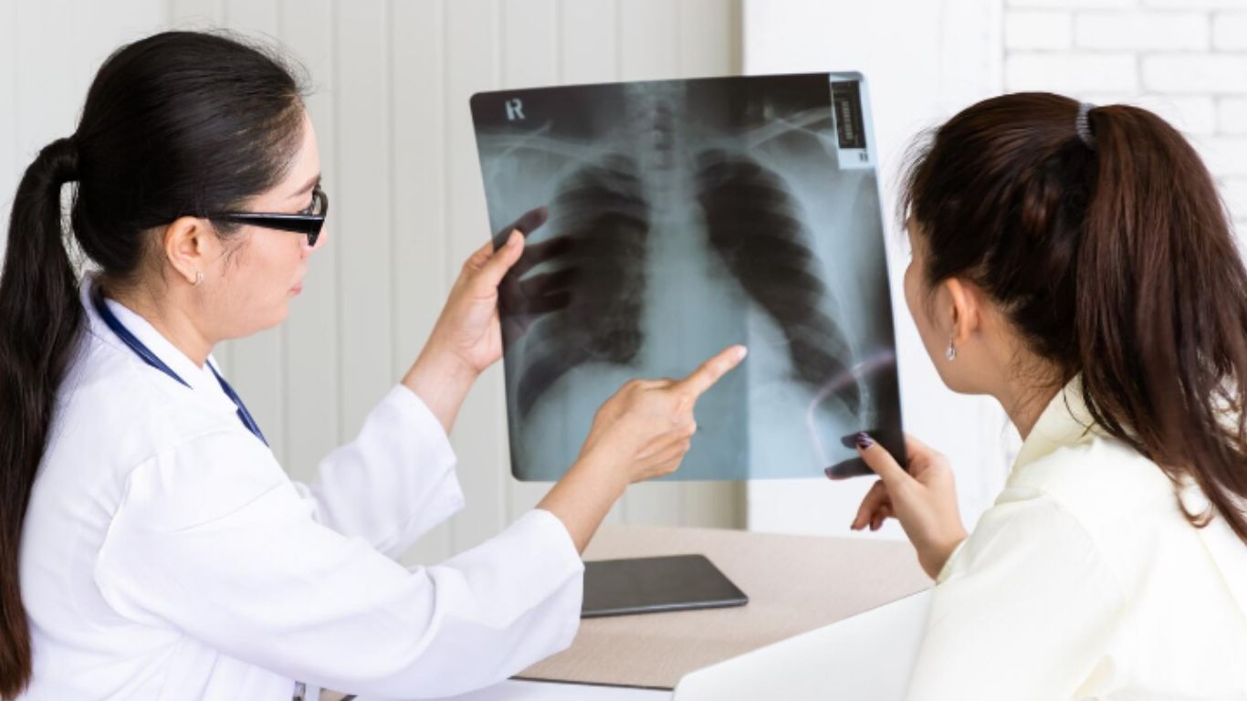 Xạ trị ung thư phổi bao nhiêu tiền? 3