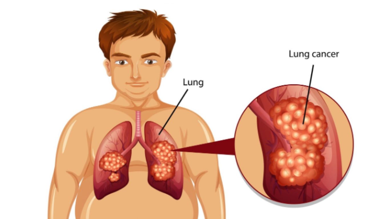 Xạ trị ung thư phổi bao nhiêu tiền? 1