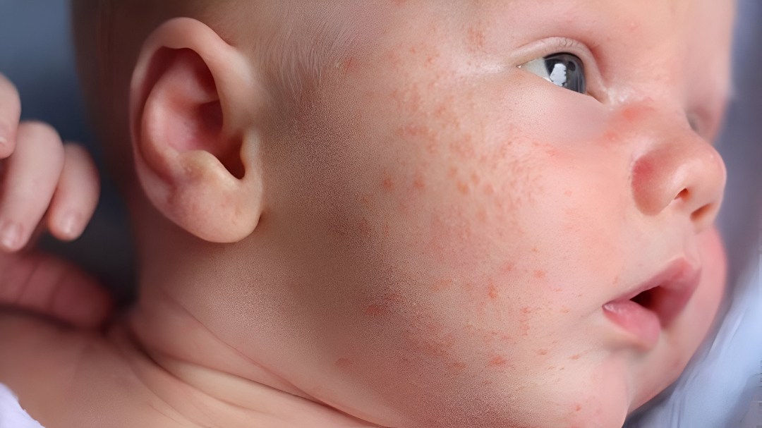 Hình ảnh các loại mụn ở trẻ sơ sinh thường gặp 1