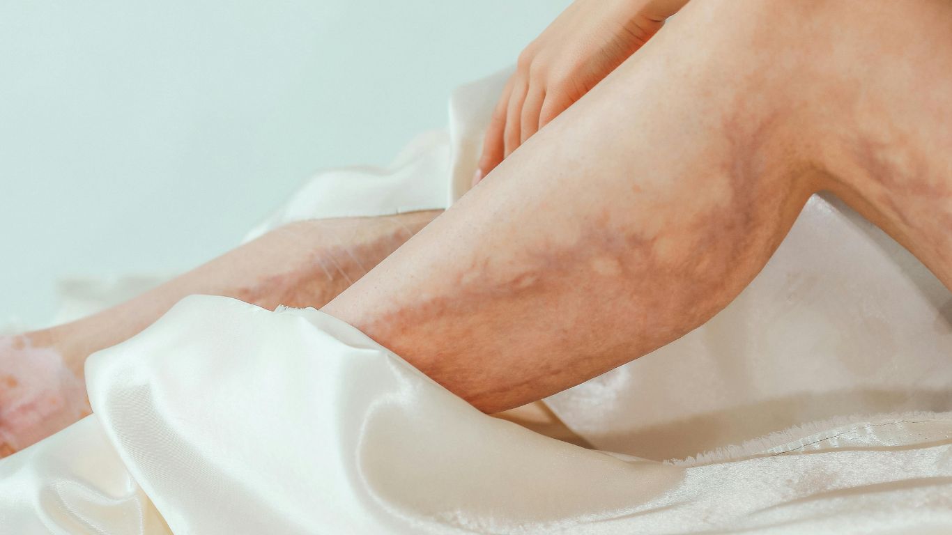 Bệnh giảm tiểu cầu có chữa được không? 3