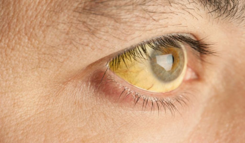 Bệnh có thể khởi phát đột ngột với các triệu chứng như mệt mỏi, vàng da và vàng mắt