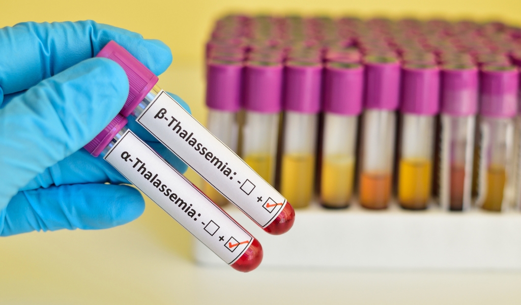 Xét nghiệm gen thalassemia giúp xác định người mang gen bệnh tan máu bẩm sinh