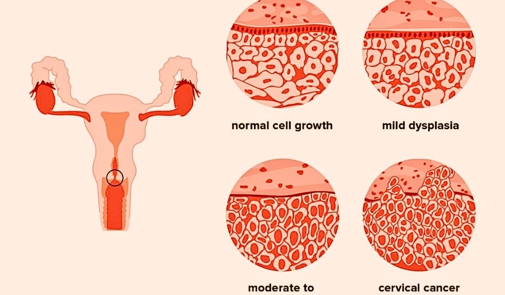 Hình ảnh minh họa tế bào cổ tử cung bình thường và bất thường